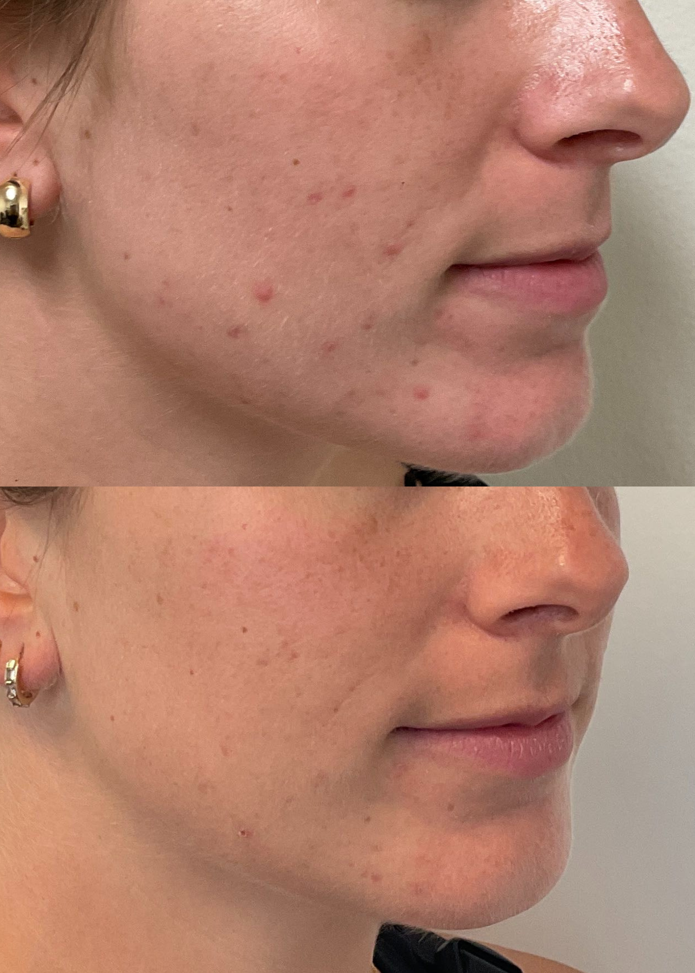 female hormonal acne before and after san francisco based dermatologist dr. caren campbell md, faad