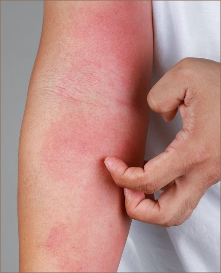 Close-up of a person's forearm with red, inflamed rashes caused by dermatitis. The individual is scratching the irritated skin, highlighting common symptoms of eczema and the need for dermatological treatment.