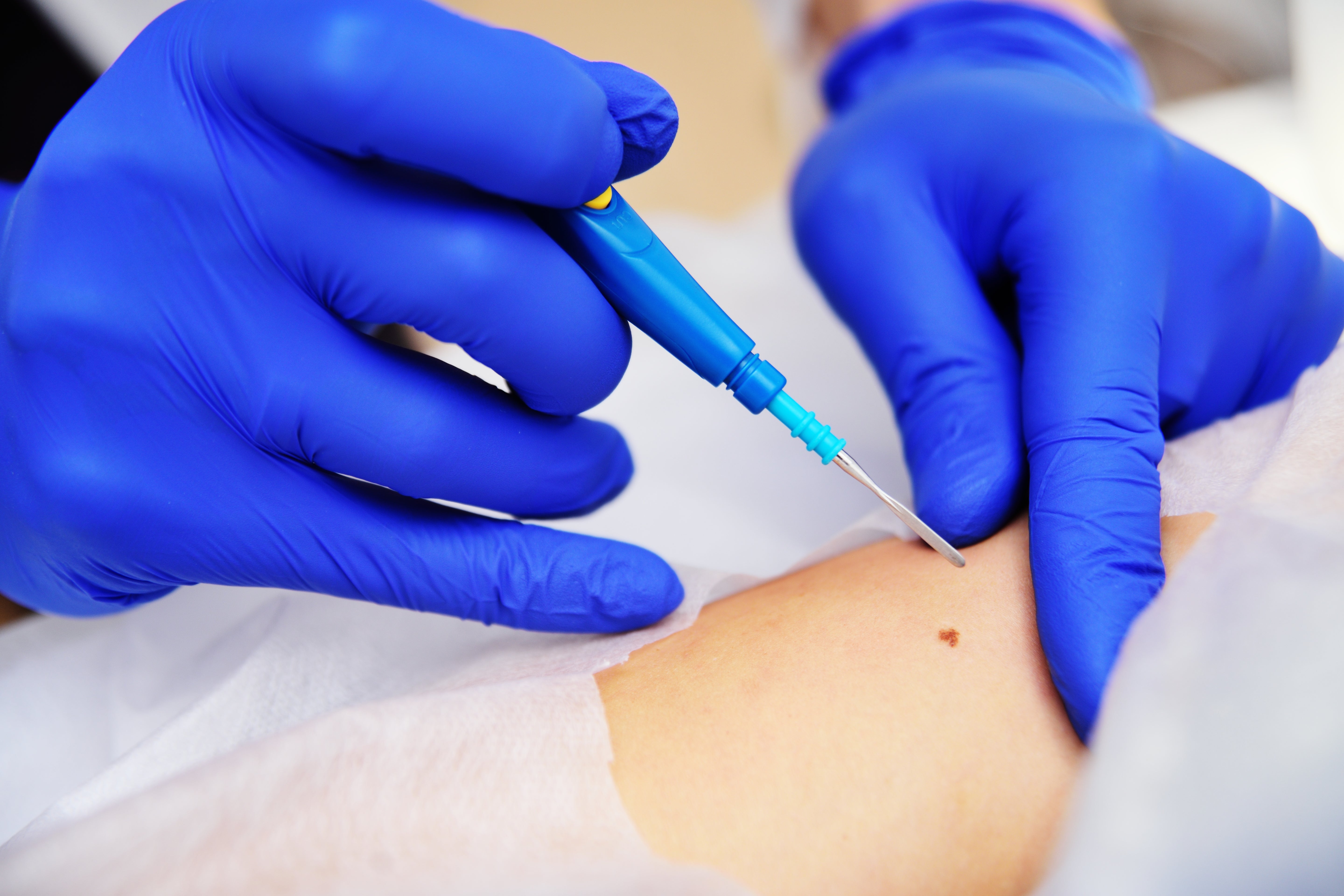 A dermatologist performing a curettage procedure on a patient in a surgical setting while wearing latex gloves.