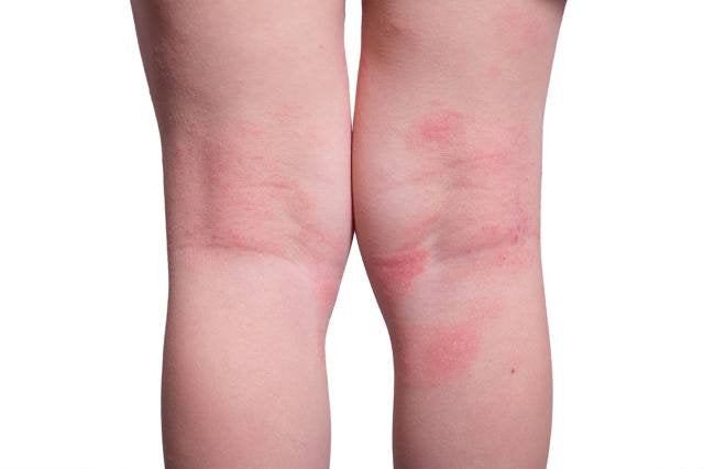 Close-up of the back of a person's knees showing red, inflamed patches caused by eczema. This image highlights common symptoms of atopic dermatitis and the need for dermatological treatment to relieve itching and irritation.