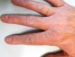 Close-up of hands with eczema, showing dry, red, and cracked skin. This image highlights common symptoms of dermatitis and the need for professional dermatological care to manage inflammation and irritation.
