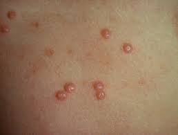 Close-up image of skin showing lesions caused by Molluscum Contagiosum, a viral skin infection. This image highlights the characteristic raised, round bumps and emphasizes the need for dermatological care in treating and managing the condition.