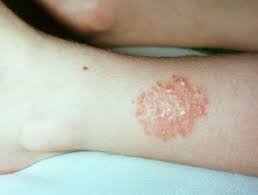 Close-up of an arm with nummular dermatitis, showing round, red, and inflamed patches of irritated skin. This image highlights common symptoms of this chronic skin condition and the importance of dermatological treatment for relief and management.