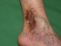 Close-up of an elderly person's foot showing signs of stasis dermatitis, including redness, swelling, and skin discoloration. This condition is associated with poor circulation and often requires dermatological care for proper management.