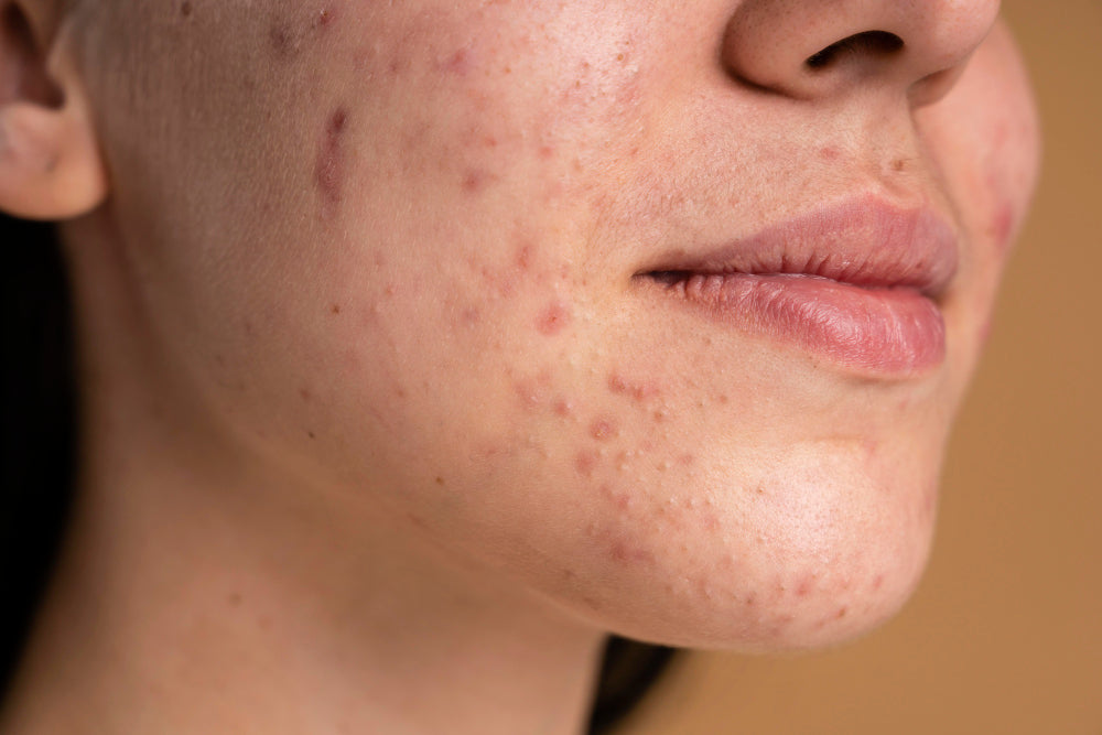 Female Hormonal Acne Treatment San Francisco