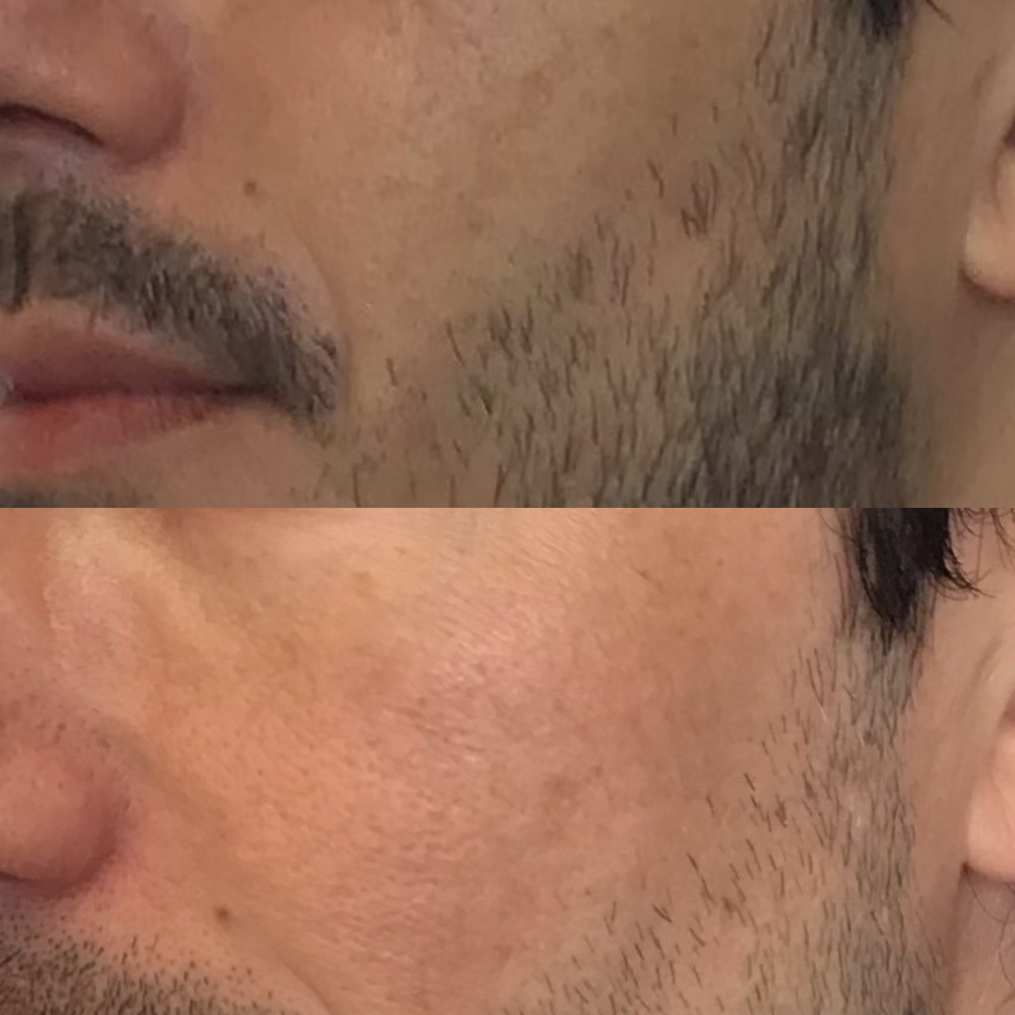 Hyperpigmentation Treatment in San Francisco: A Dermatologist's Complete Guide