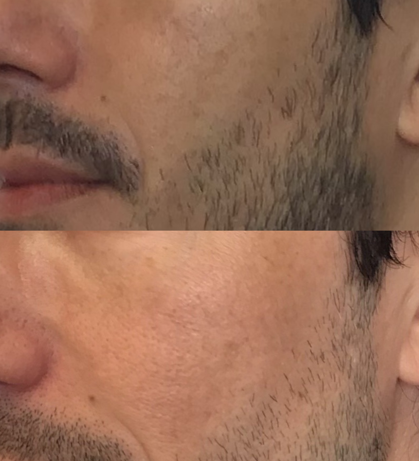 Hyperpigmentation Treatment in San Francisco: A Dermatologist's Complete Guide