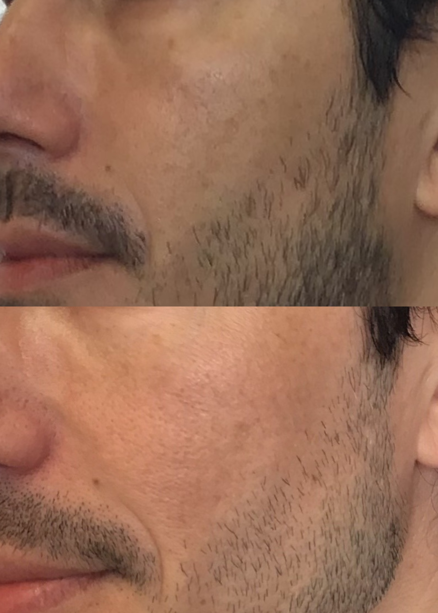 Hyperpigmentation Treatment in San Francisco: A Dermatologist's Complete Guide