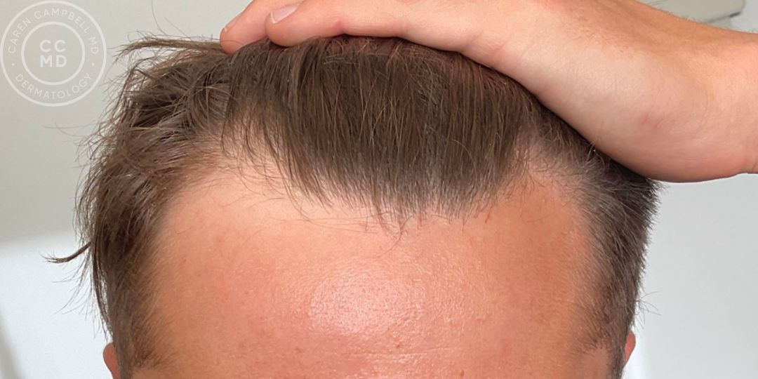 hair-loss-treatment-san-francisco-ccmd-dermatology