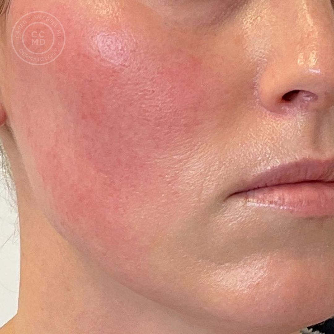 Rosacea Treatment Near Me in San Francisco: Expert Care by Dr. Caren Campbell MD, FAAD