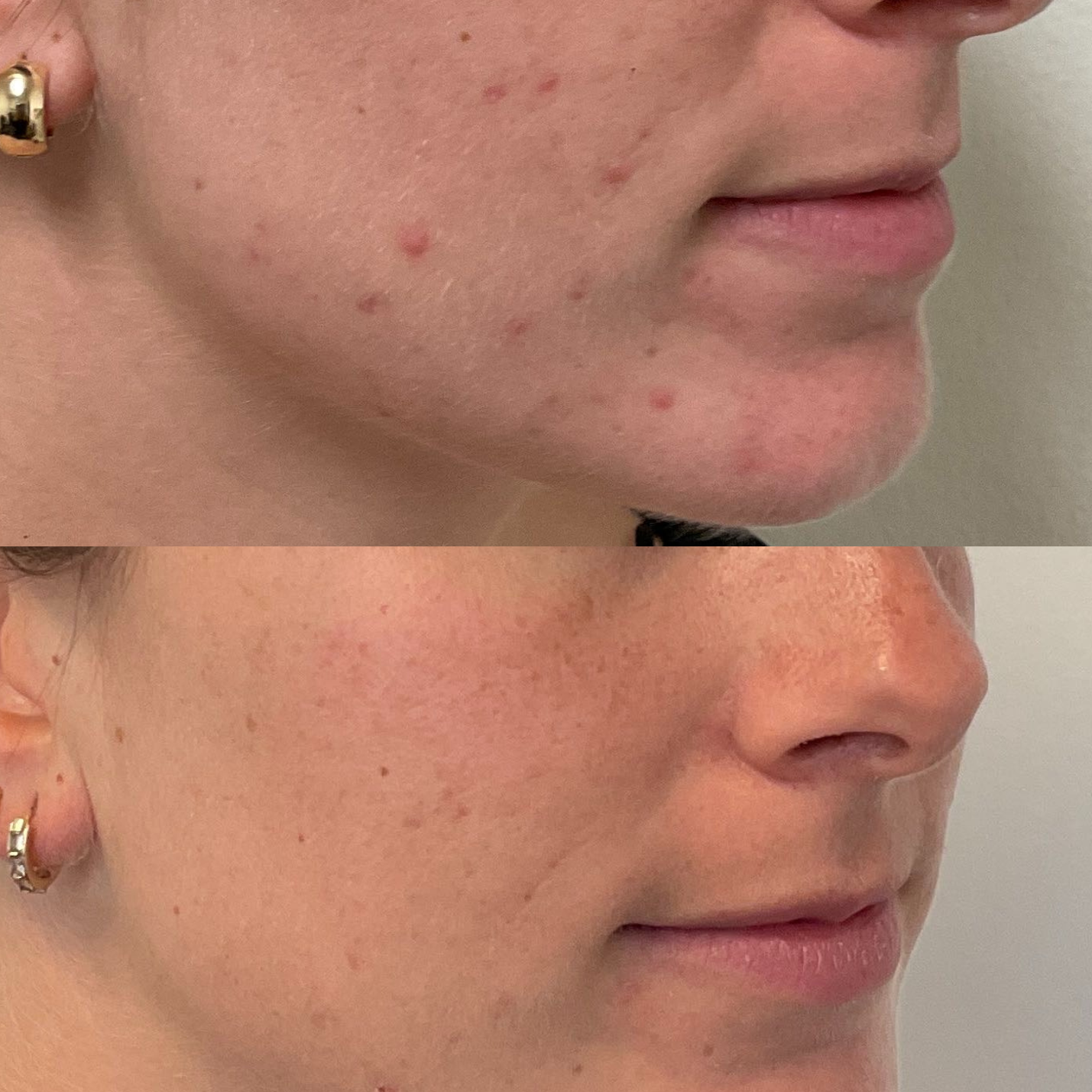 female hormonal acne before and after san francisco based dermatologist dr. caren campbell md, faad