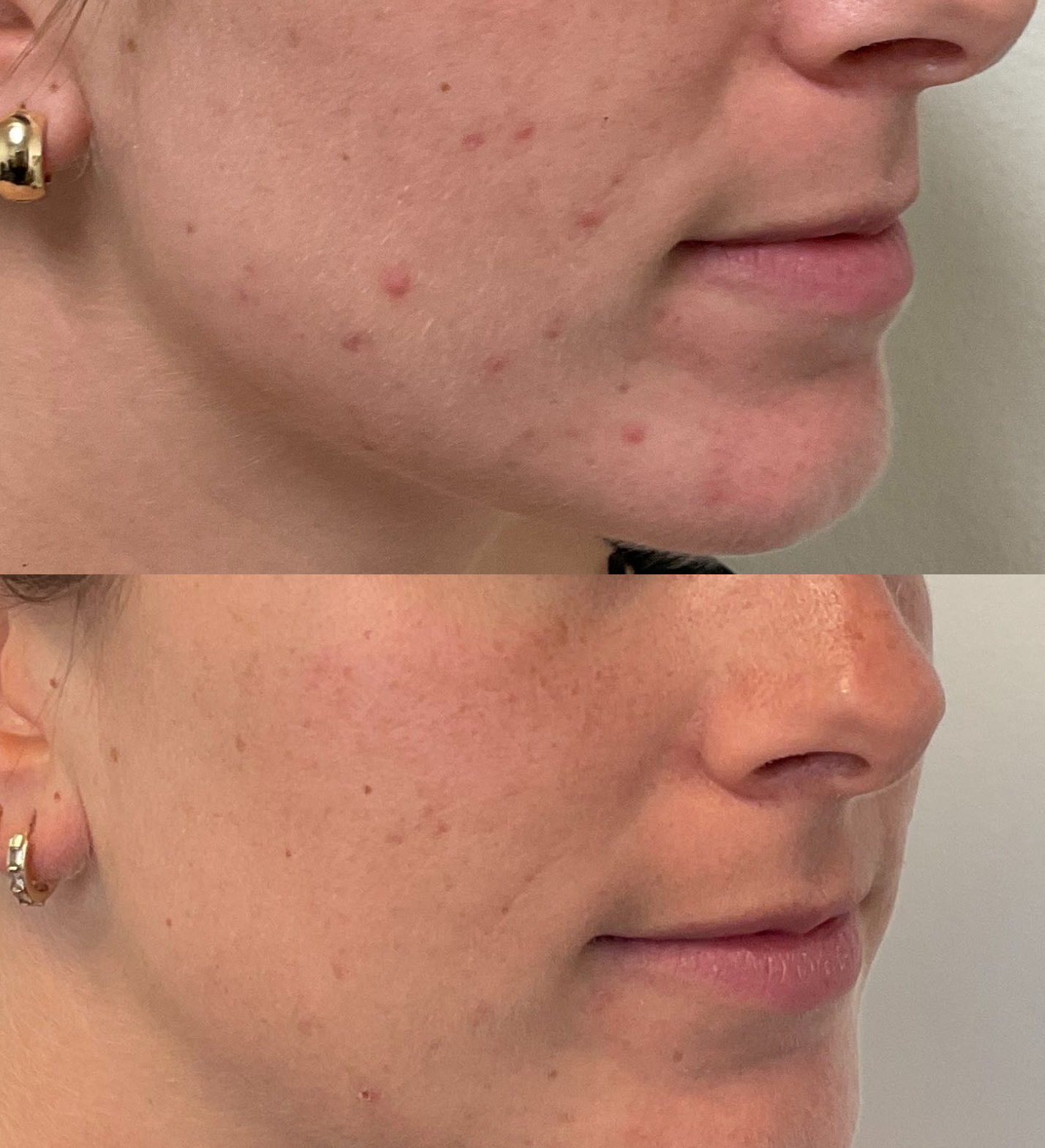 female hormonal acne before and after san francisco based dermatologist dr. caren campbell md, faad