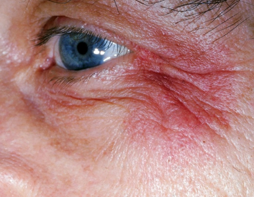 clinical photo showing unilateral and bilateral eyelid dermatitis, presenting with redness, swelling, and scaling on the upper and lower eyelids and left cheek due to an allergic reaction to eye medications