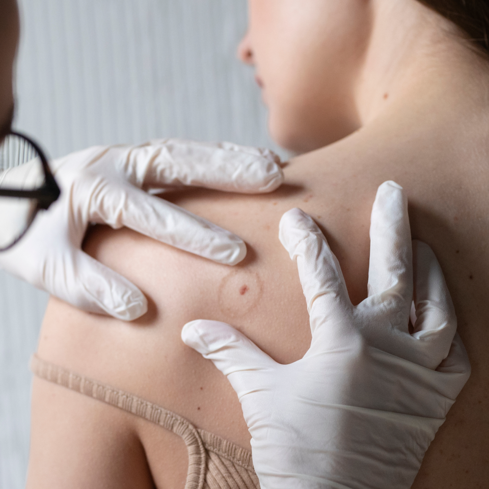Board-certified San Francisco dermatologist examining sun-damaged skin to help prevent basal cell carcinoma, squamous cell carcinoma, and actinic keratoses through early detection and evidence-based treatment.