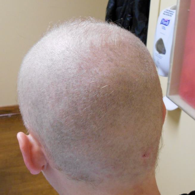 dr caren campbell board certified dermatologist in san francisco diagnosed rare case of thallium poisoning in residency causing systemic symptoms and hair loss. 