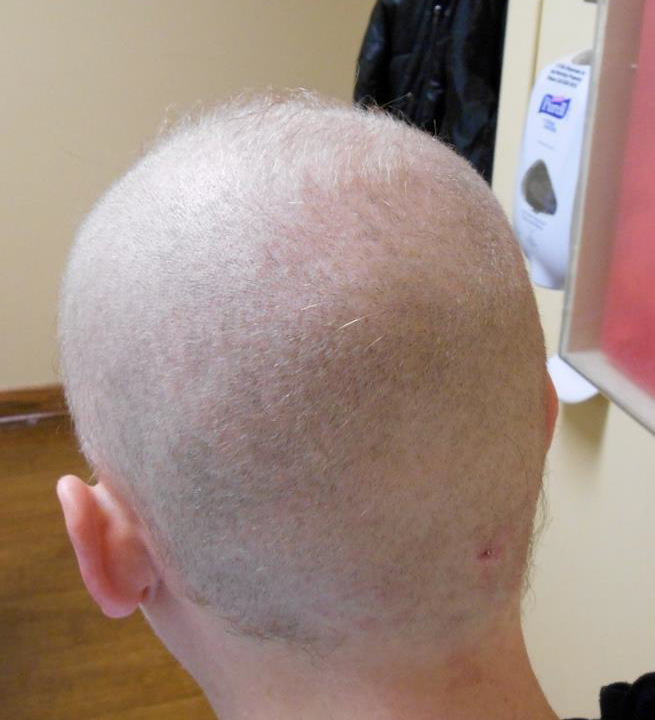 dr caren campbell board certified dermatologist in san francisco diagnosed rare case of thallium poisoning in residency causing systemic symptoms and hair loss. 