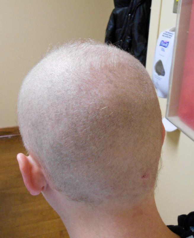 dr caren campbell board certified dermatologist in san francisco diagnosed rare case of thallium poisoning in residency causing systemic symptoms and hair loss. 