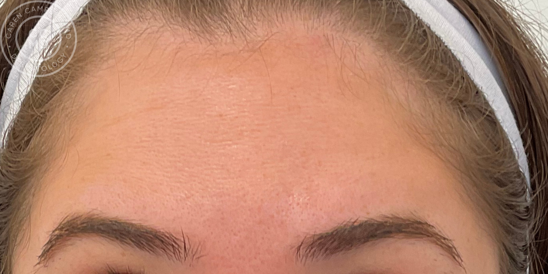 Forhead Rytid Before and After: Wrinkle Relaxer — San Francisco Dermatology | Best ...