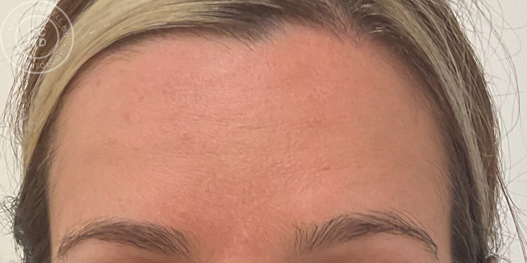 Dynamic Rhytids Before and After: Wrinkle Relaxer — San Francisco Dermatology | Best ...