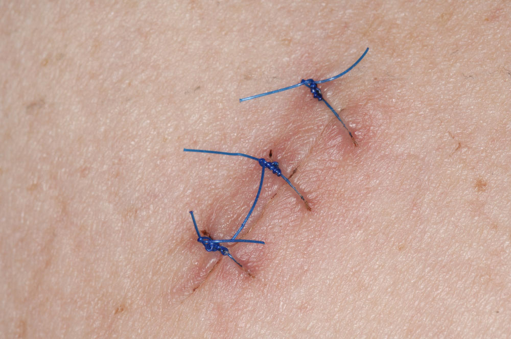 Dr. Caren Campbell blending cosmetic precision with surgical dermatology for minor cyst or mole removal in a private setting.
