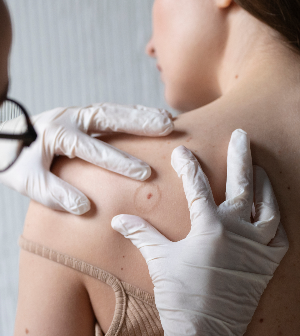 Board-certified San Francisco dermatologist examining a mole on a patient's back at Caren Campbell MD Dermatology, offering skin cancer biopsies, excisions, and mole removal