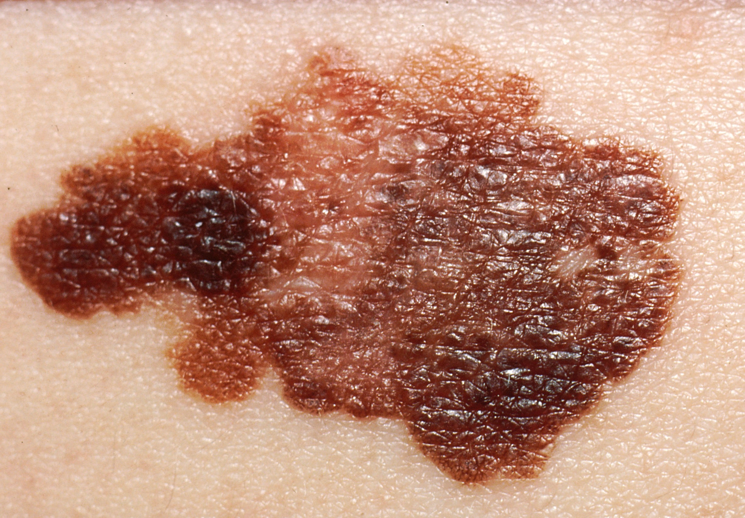 Board-certified dermatologist Dr. Caren Campbell performing a comprehensive medical skin cancer screening in her San Francisco office.