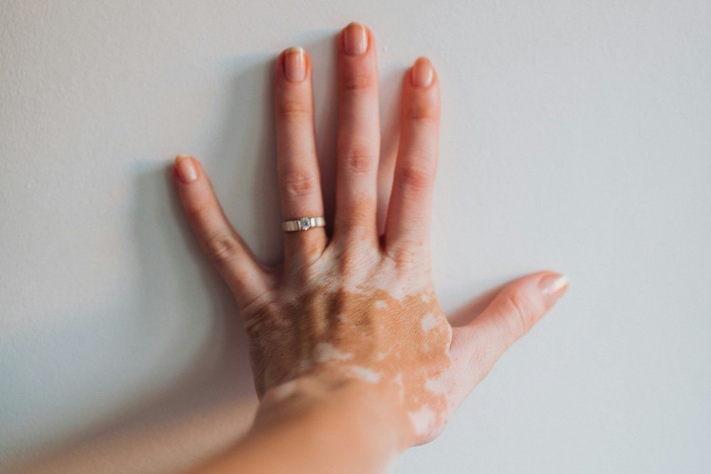 Close-up of a woman's hand with a ring, showing vitiligo patches on the skin against a white background. This image highlights the appearance of vitiligo and the importance of dermatological care for skin pigmentation disorders.