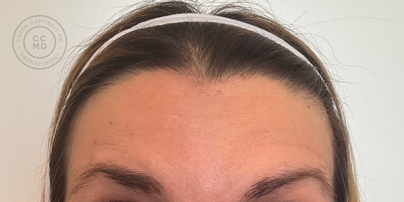 Dynamic Rhytids Before and After: Wrinkle Relaxer — San Francisco Dermatology | Best ...