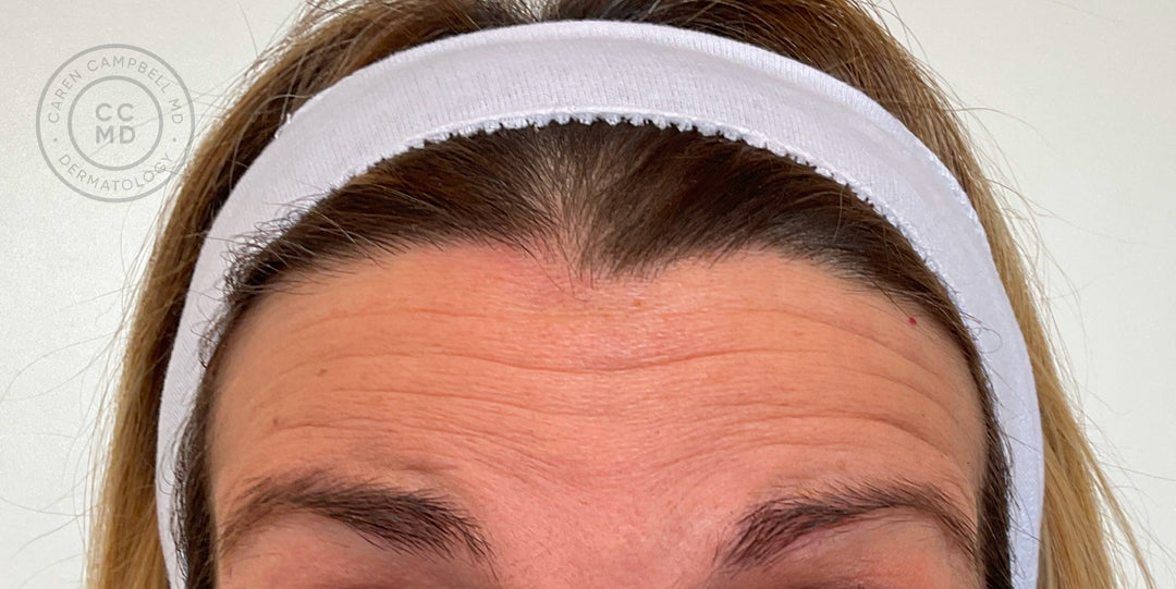 Dynamic Rhytids Before and After: Wrinkle Relaxer — San Francisco Dermatology | Best ...